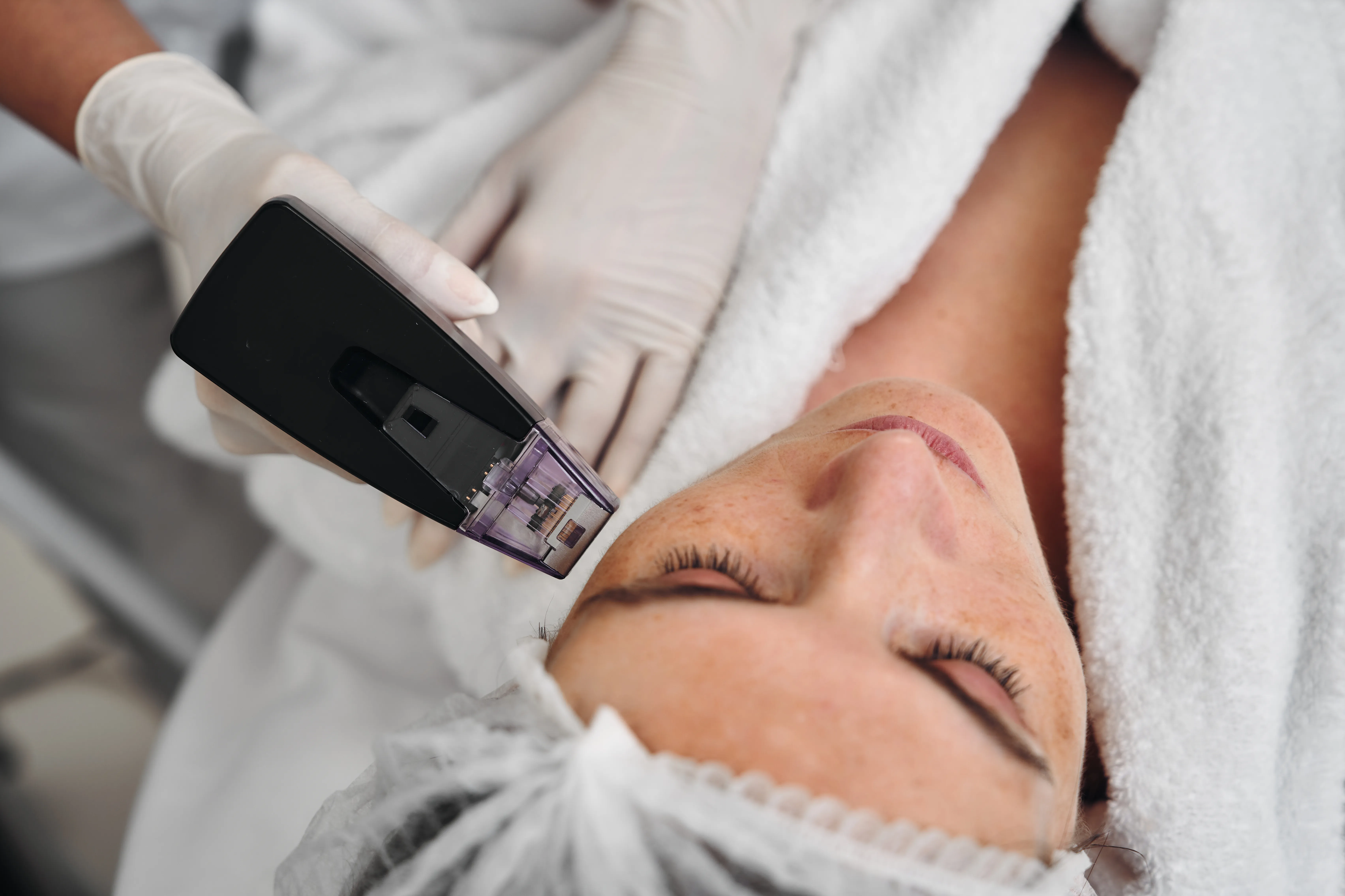 Morpheus8 vs. Traditional Microneedling: What’s the Difference?